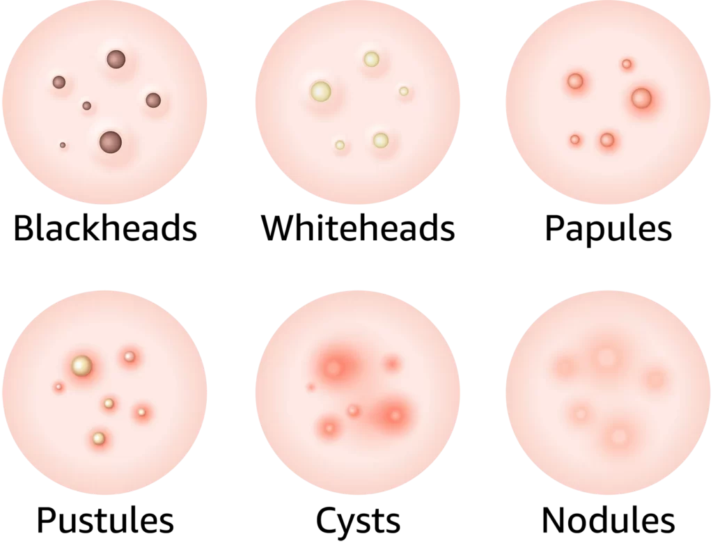 Types of acne