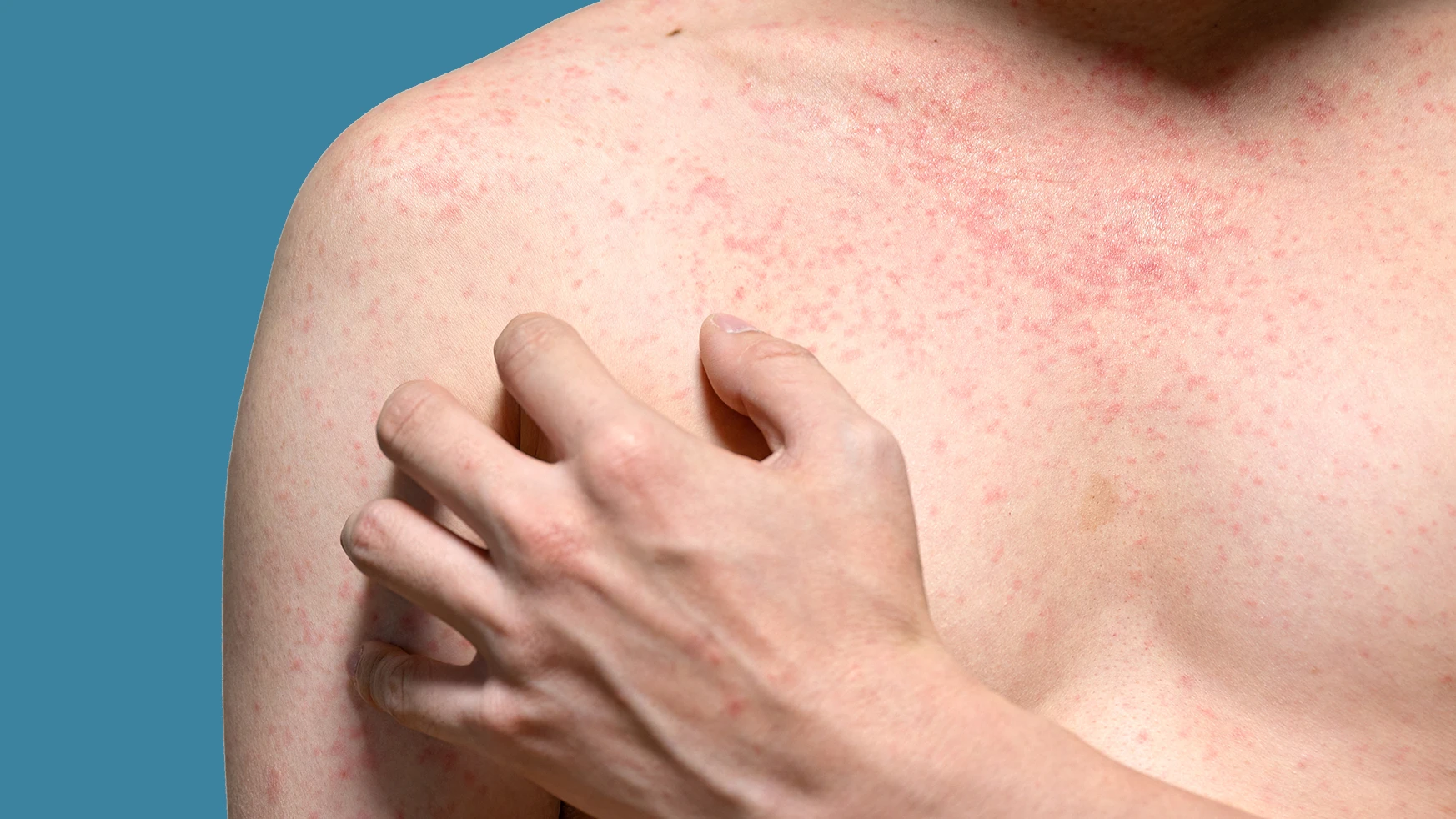 man with itchy red bumps on his chest - get rid of malassezia naturally