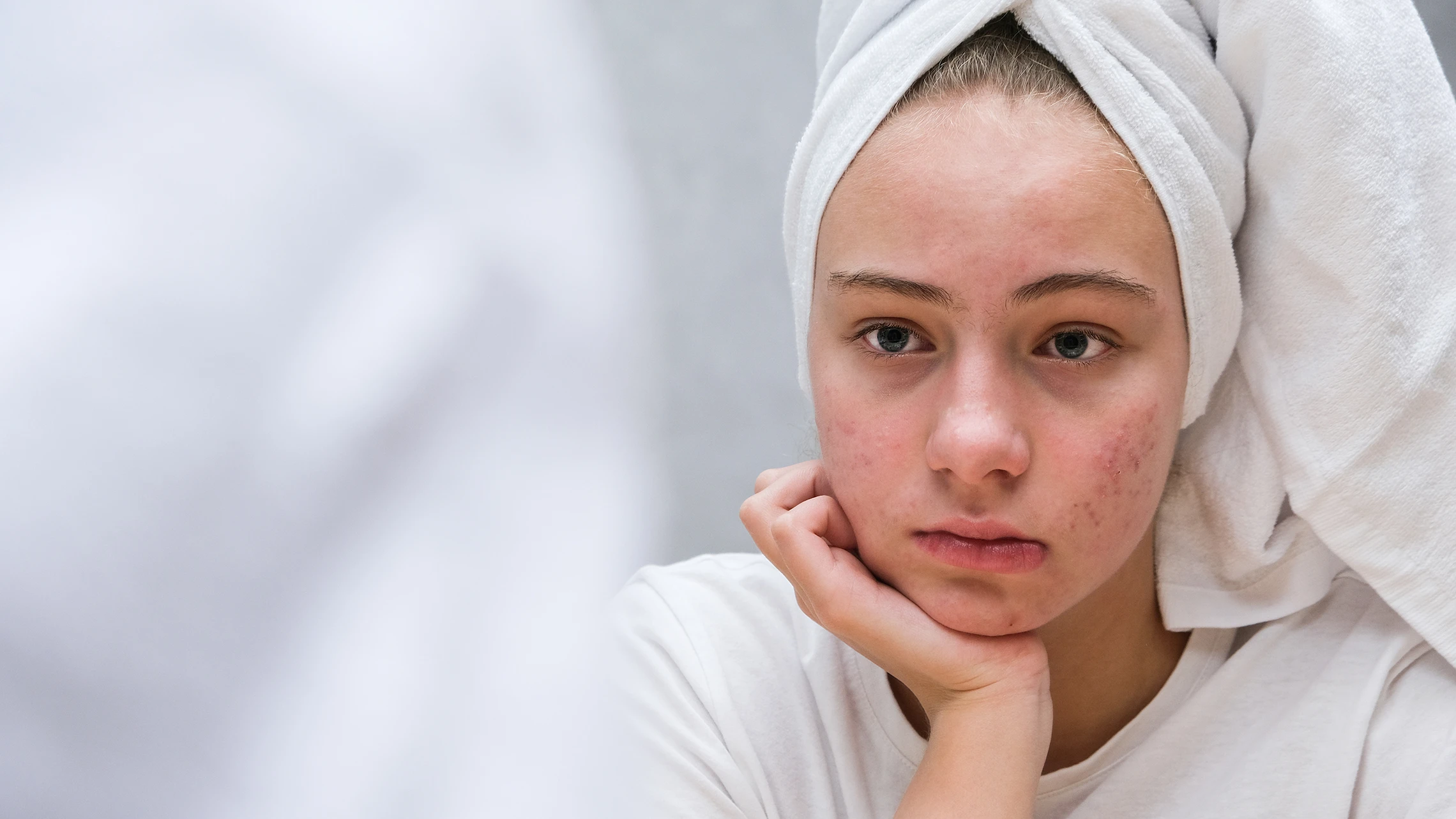 Fungal Acne vs Regular Acne - Sad teenage girl considering her problem skin