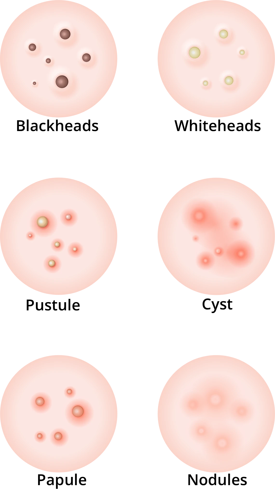 An educational medical illustration chart displaying the six primary types of acne lesions: blackheads, whiteheads, papules, pustules, cysts, and nodules on human skin.